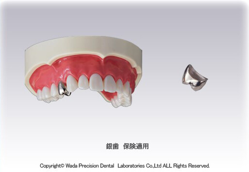 銀歯　保険適用
